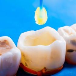 Choosing the Perfect Tooth Filling Material: A Comprehensive Guide to Your Options